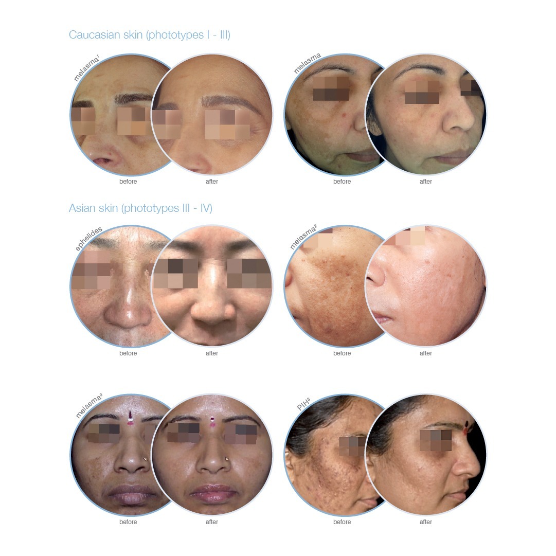 Before and after images showing treatment results for melasma on Caucasian and Asian skin types. The top section features Caucasian skin (phototypes I-III), while the bottom section focuses on Asian skin (phototypes III-IV). Each set highlights the improvement in skin appearance, showcasing various melasma and pigmentation conditions.
