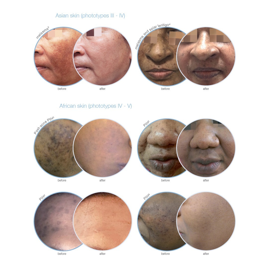 Before and after images showcasing skin treatments for Asian and African skin types, specifically addressing conditions like melasma, solar lentigo, and post-inflammatory hyperpigmentation (PIH). The top section features Asian skin (phototypes III-IV), while the bottom section highlights African skin (phototypes IV-V), illustrating the effectiveness of various dermatological procedures.