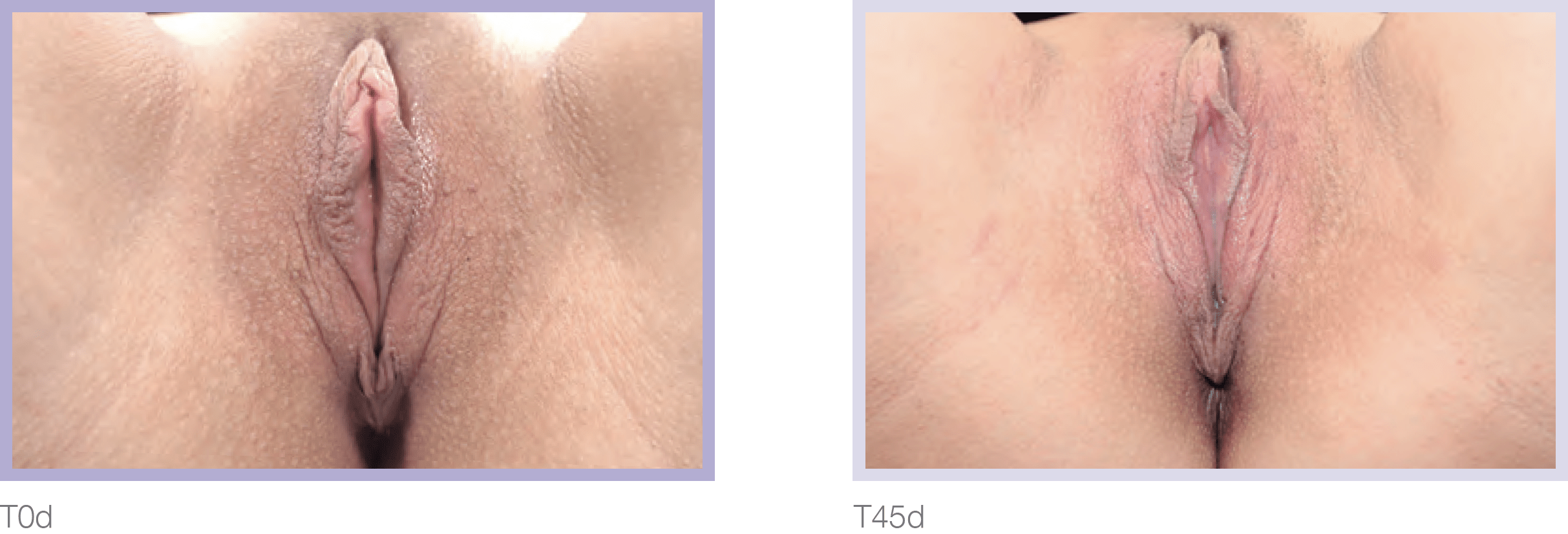Image comparing two vulvar anatomies labeled TOd and T45d, highlighting variations in appearance and structure for educational purposes in gynecology.