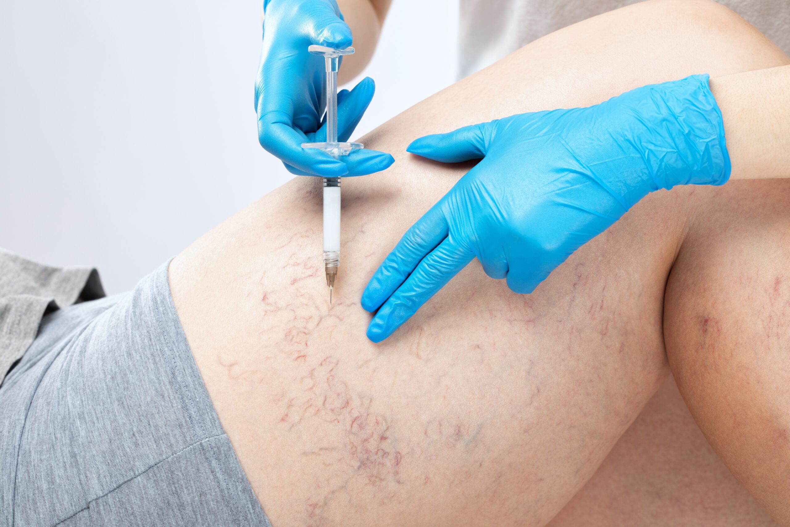 Sclerotherapy v. Laser for Spider Veins: Which Works Better?
