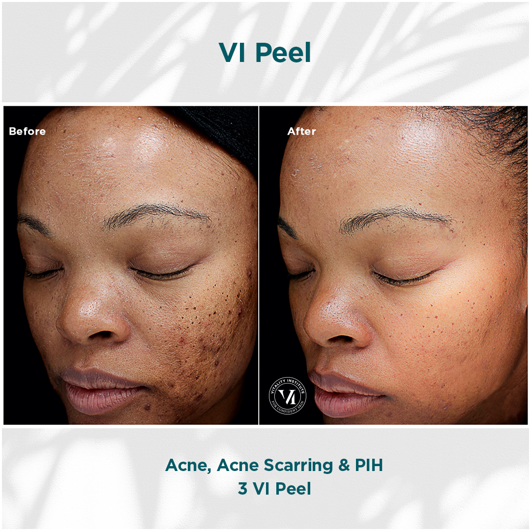 Before and after images showcasing the results of a VI Peel treatment for acne, acne scarring, and post-inflammatory hyperpigmentation (PIH). The left side displays the skin condition before treatment, while the right side illustrates the improved skin appearance after three VI Peel sessions.