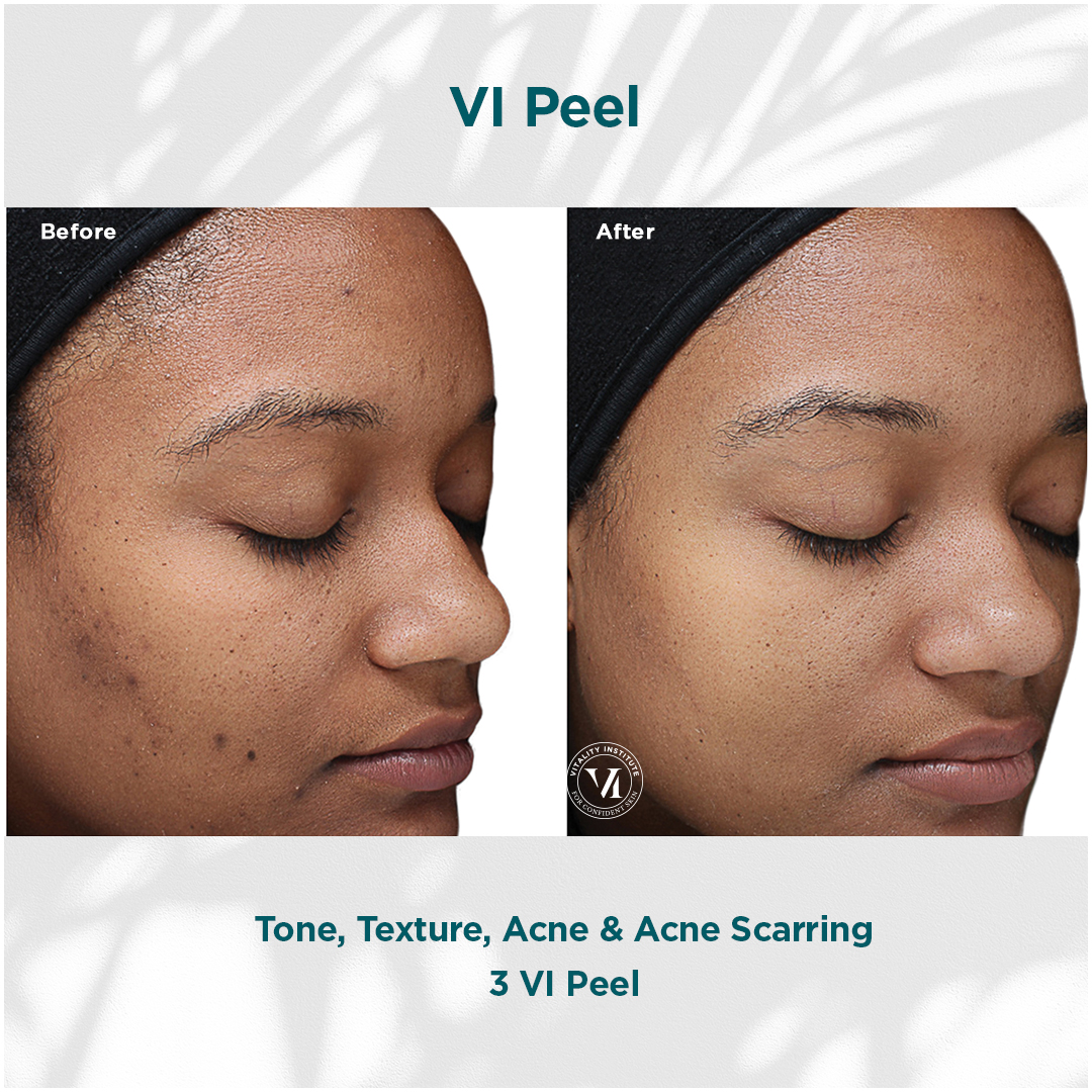 Before and after comparison of a VI Peel treatment showing improved skin tone and texture, reduction of acne and acne scarring. The image highlights the effectiveness of three VI Peels in enhancing skin appearance.