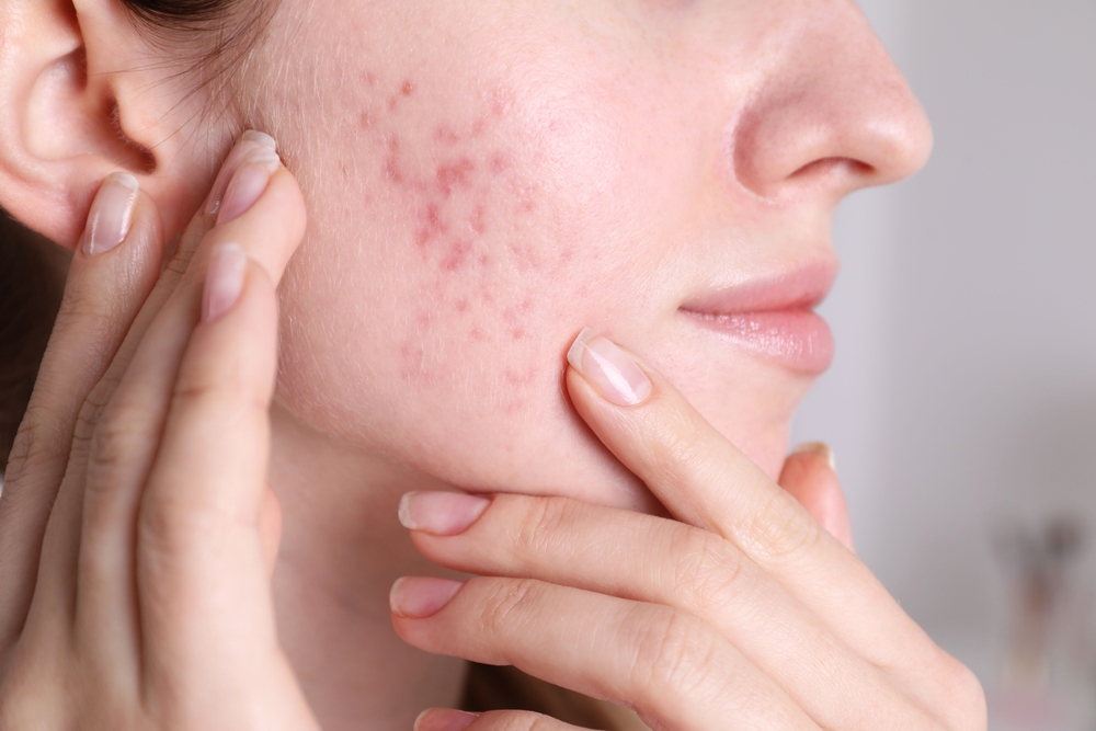 Close-up of a woman examining her cheek with acne scars, highlighting skin texture and blemishes. This image illustrates common skin concerns related to acne and skincare routines.