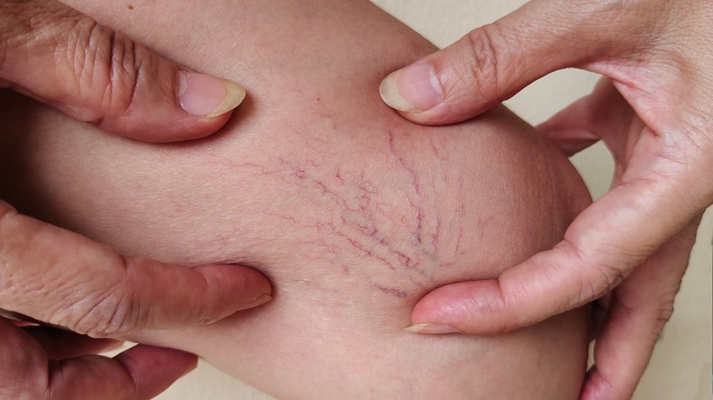 Close-up of a person's knee with visible spider veins being examined by hands, highlighting common signs of venous insufficiency or circulatory issues.