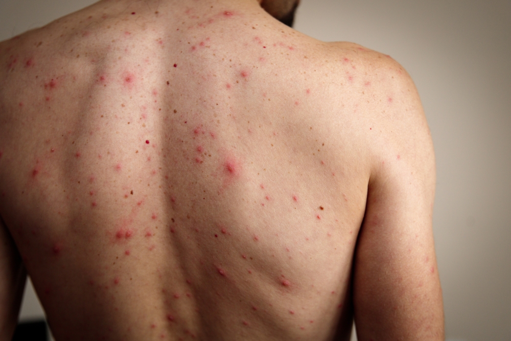 Back view of a person with acne on their shoulders and upper back, showcasing red spots and blemishes, indicative of skin conditions such as body acne or folliculitis.