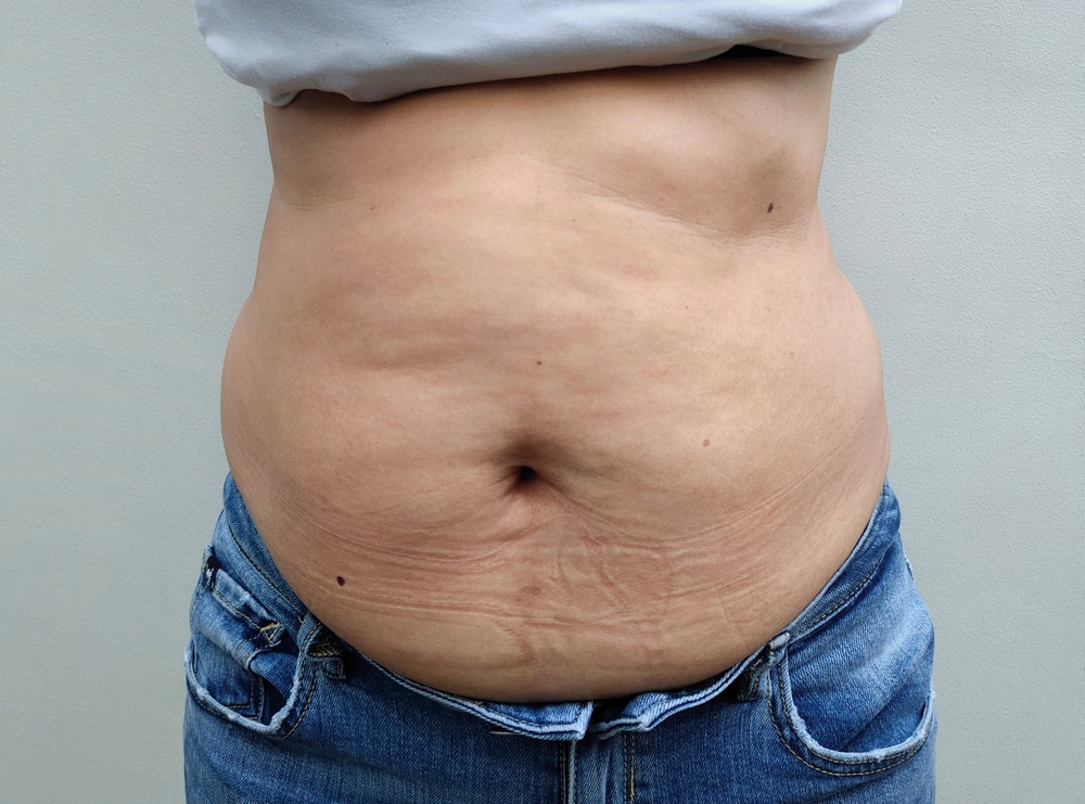 The “Modern Mommy Makeover”: Non-Surgical Solutions for Post-Baby Skin Laxity